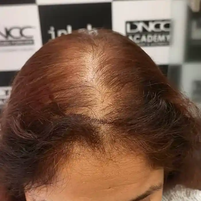 Female Hair Transplant